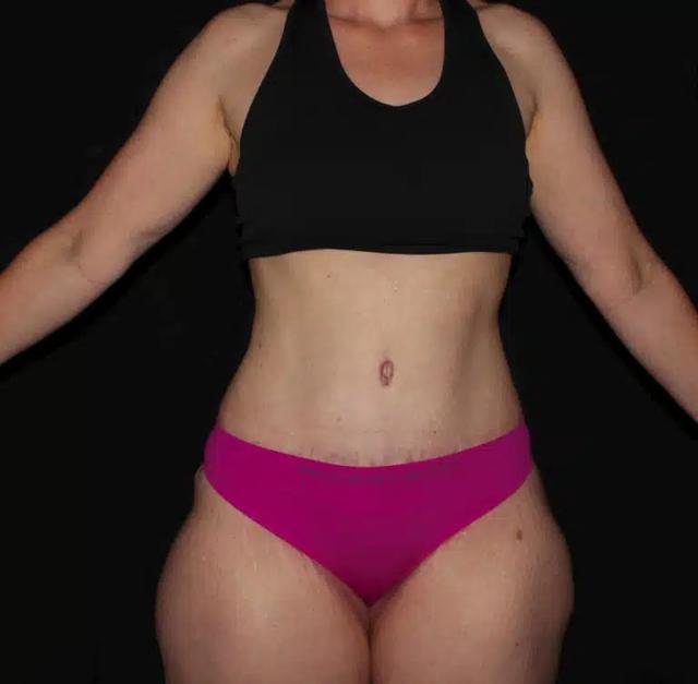 Mommy Makeover after at Silk Touch Cosmetic Surgery & Medspa in Boise, ID