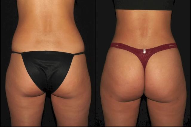 Brazilian Butt Lift result at Silk Touch Cosmetic Surgery & Medspa in Boise, ID
