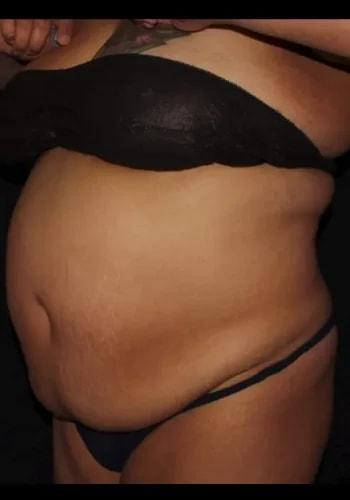 Liposuction before at Silk Touch Cosmetic Surgery & Medspa in Boise, ID