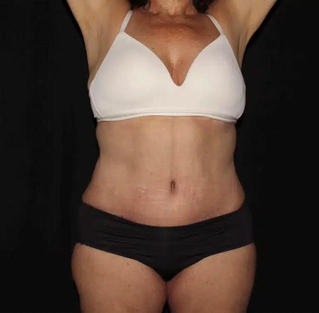 Mommy Makeover after at Silk Touch Cosmetic Surgery & Medspa in Boise, ID