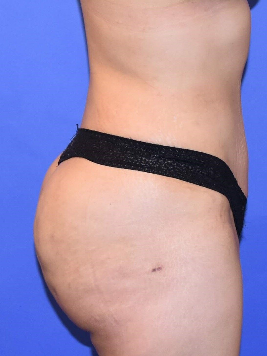 Rafi S. Bidros, MD bbl after — Houston, TX