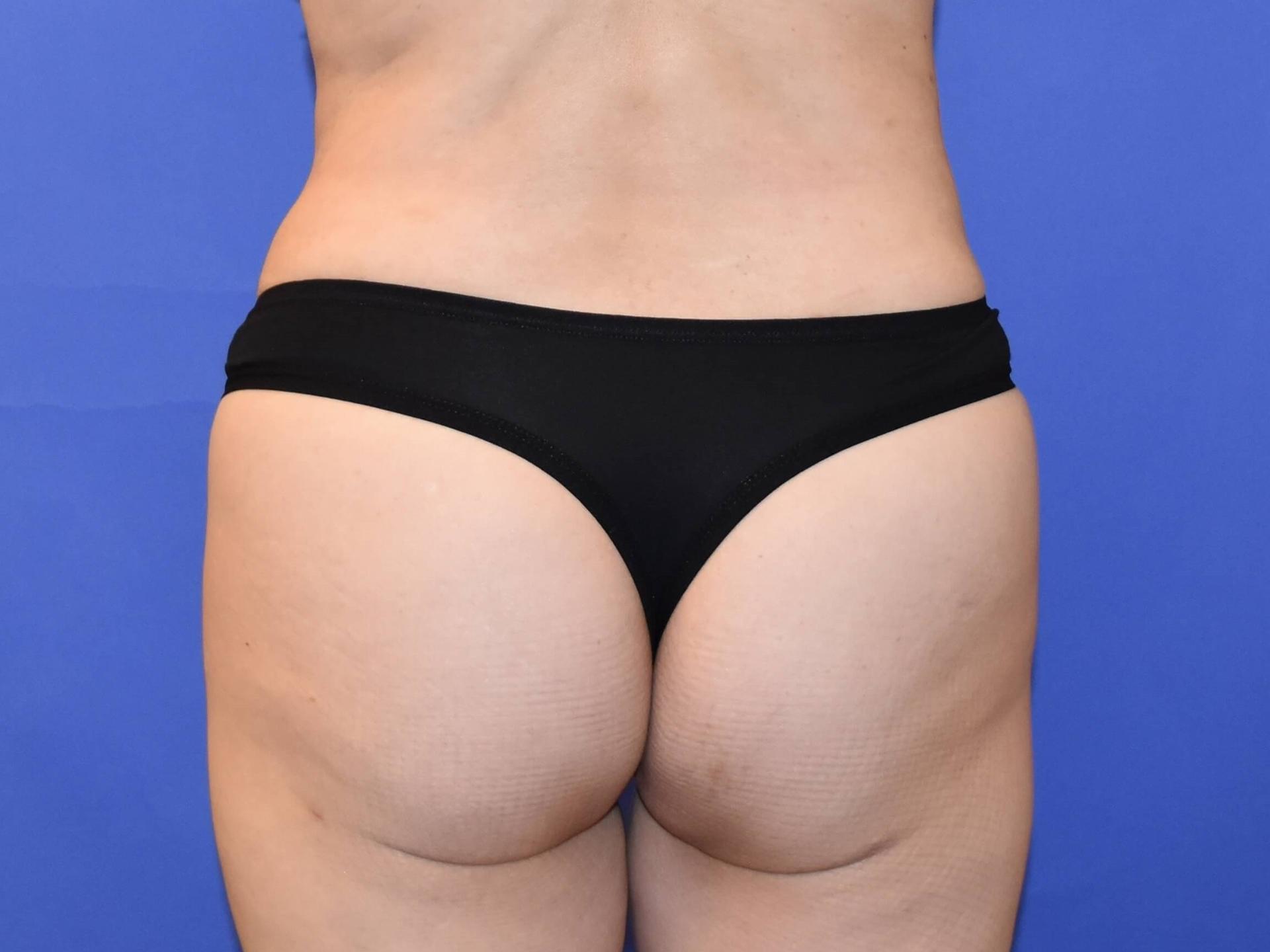 Rafi S. Bidros, MD bbl after — Houston, TX