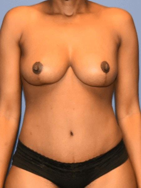 Rafi S. Bidros, MD mommy makeover after — Houston, TX