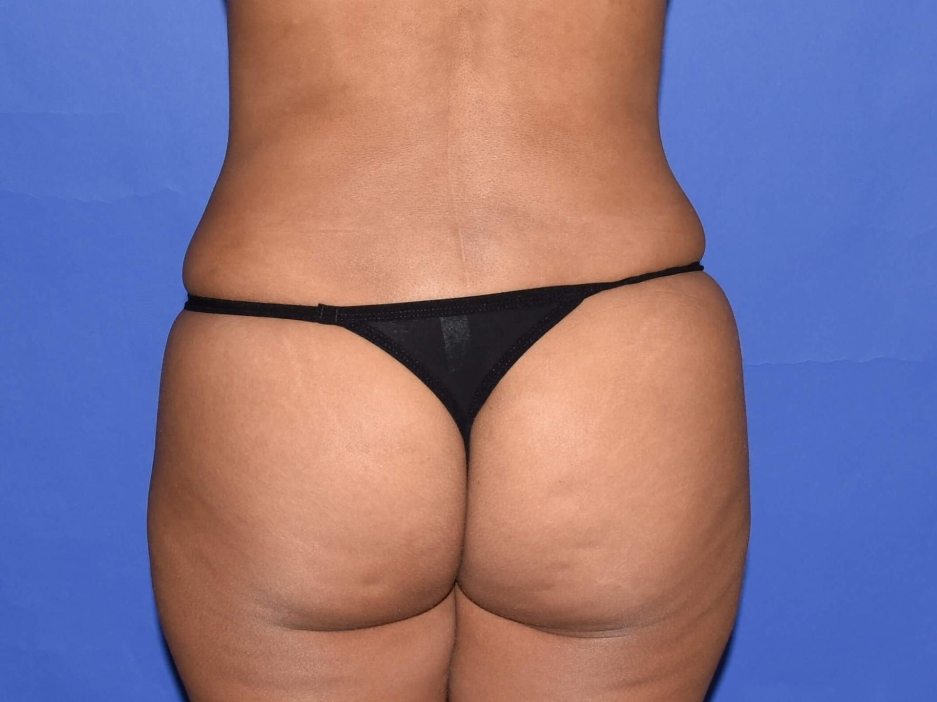 Rafi S. Bidros, MD bbl after — Houston, TX