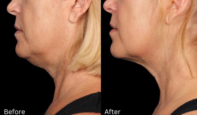 Neck Lift result at Chernoff Cosmetic Surgery in Indianapolis, IN