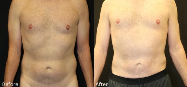 Thigh Lift result at Chernoff Cosmetic Surgery in Indianapolis, IN