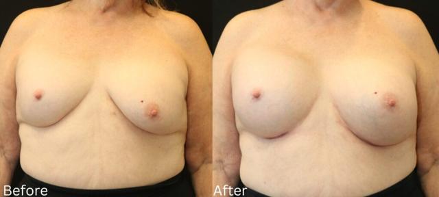 Breast Augmentation result at Chernoff Cosmetic Surgery in Indianapolis, IN
