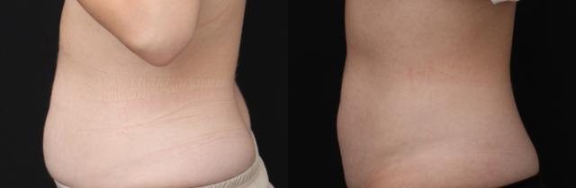 Thigh Lift result at Chernoff Cosmetic Surgery in Indianapolis, IN