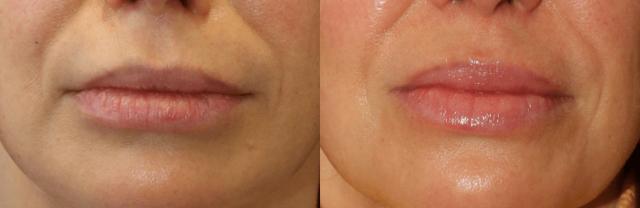 Lip Filler result at Chernoff Cosmetic Surgery in Indianapolis, IN