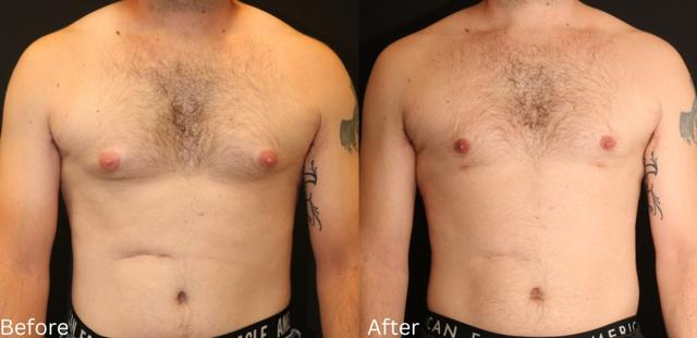 Breast Augmentation result at Chernoff Cosmetic Surgery in Indianapolis, IN