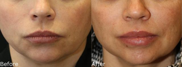 Lip Filler result at Chernoff Cosmetic Surgery in Indianapolis, IN