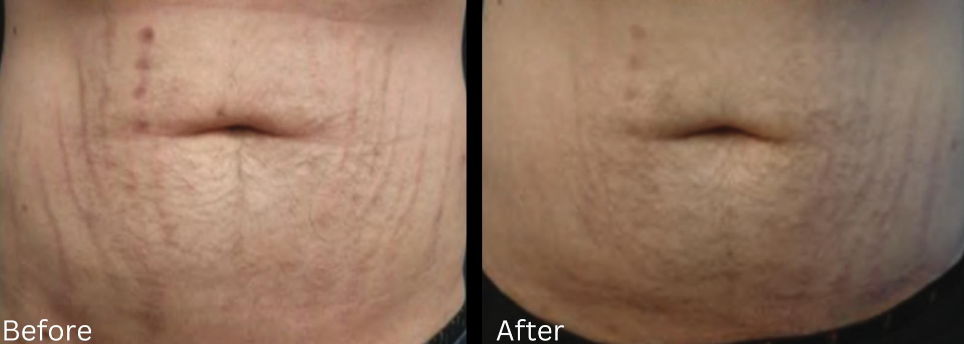 Chernoff Cosmetic Surgery scar treatment result — Indianapolis, IN