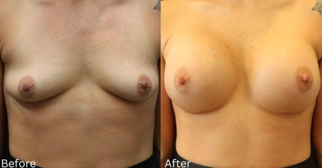 Breast Augmentation result at Chernoff Cosmetic Surgery in Indianapolis, IN