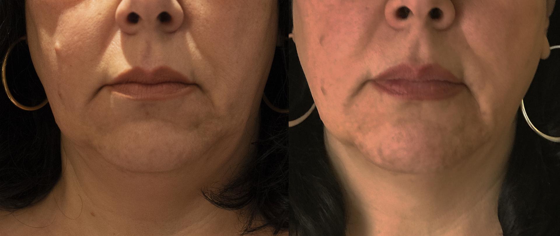 Chernoff Cosmetic Surgery skin tightening result — Indianapolis, IN