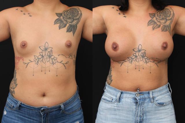 Breast Augmentation result at Chernoff Cosmetic Surgery in Indianapolis, IN