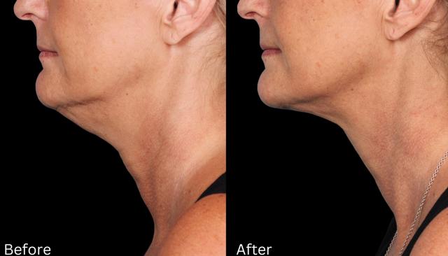 Neck Lift result at Chernoff Cosmetic Surgery in Indianapolis, IN