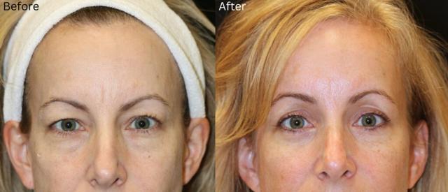 Breast Augmentation result at Chernoff Cosmetic Surgery in Indianapolis, IN