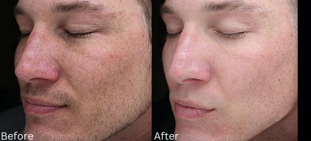 Chemical Peel result at Chernoff Cosmetic Surgery in Indianapolis, IN