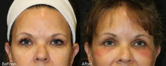 Breast Augmentation result at Chernoff Cosmetic Surgery in Indianapolis, IN