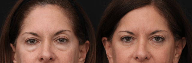 Blepharoplasty result at Chernoff Cosmetic Surgery in Indianapolis, IN