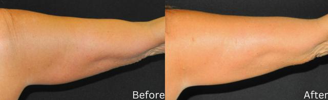 Thigh Lift result at Chernoff Cosmetic Surgery in Indianapolis, IN