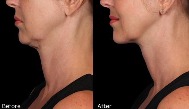 Neck Lift result at Chernoff Cosmetic Surgery in Indianapolis, IN