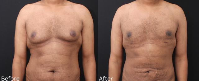Breast Reduction result at Chernoff Cosmetic Surgery in Indianapolis, IN
