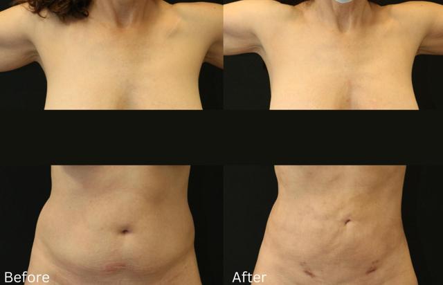 Liposuction result at Chernoff Cosmetic Surgery in Indianapolis, IN