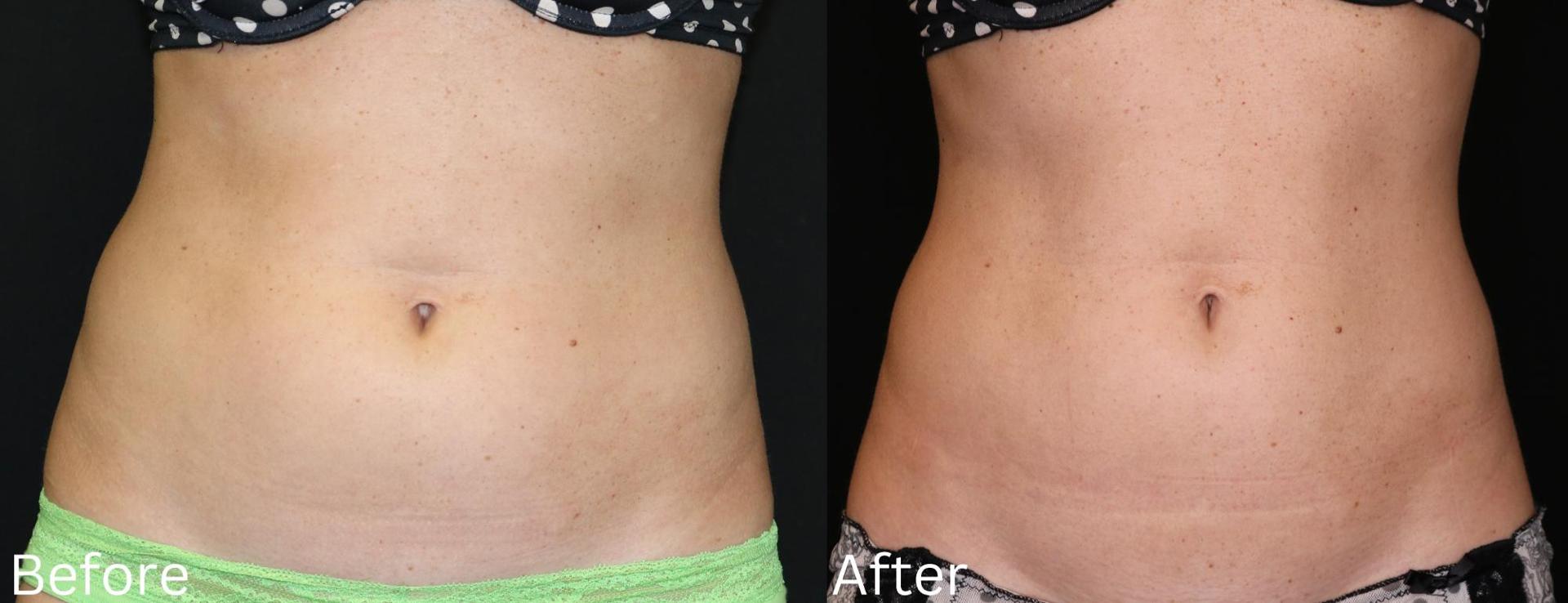 Chernoff Cosmetic Surgery fat freezing result — Indianapolis, IN