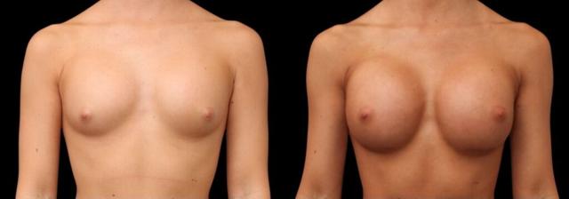 Breast Augmentation result at Chernoff Cosmetic Surgery in Indianapolis, IN