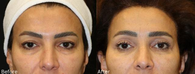 Breast Augmentation result at Chernoff Cosmetic Surgery in Indianapolis, IN