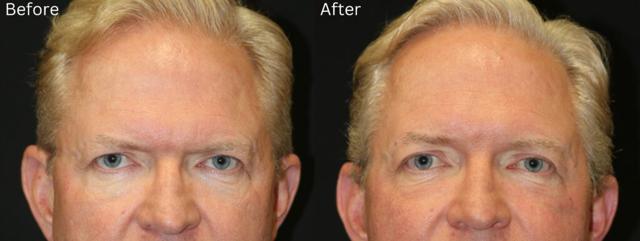 Breast Augmentation result at Chernoff Cosmetic Surgery in Indianapolis, IN