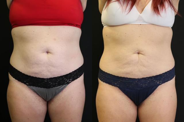 CoolSculpting result at Chernoff Cosmetic Surgery in Indianapolis, IN