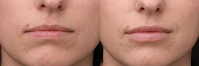 Lip Filler result at Chernoff Cosmetic Surgery in Indianapolis, IN