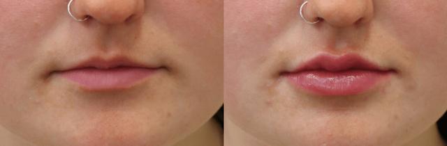 Lip Filler result at Chernoff Cosmetic Surgery in Indianapolis, IN
