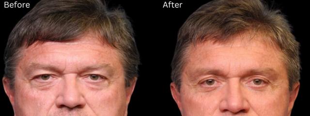 Brow Lift result at Chernoff Cosmetic Surgery in Indianapolis, IN