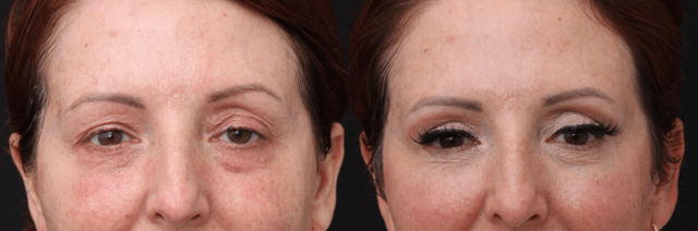 Blepharoplasty result at Chernoff Cosmetic Surgery in Indianapolis, IN