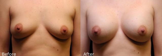 Breast Augmentation result at Chernoff Cosmetic Surgery in Indianapolis, IN