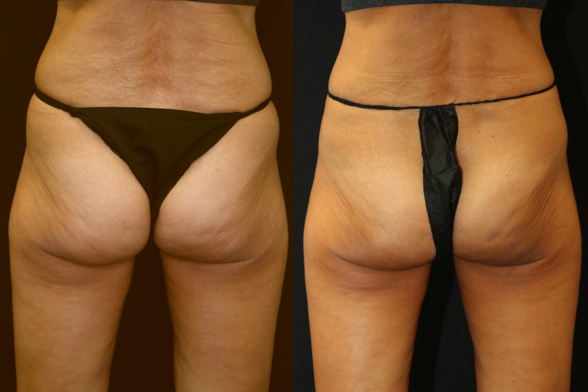 Chernoff Cosmetic Surgery fat freezing result — Indianapolis, IN