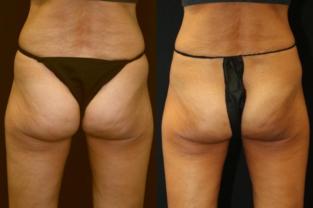 Thigh Lift result at Chernoff Cosmetic Surgery in Indianapolis, IN