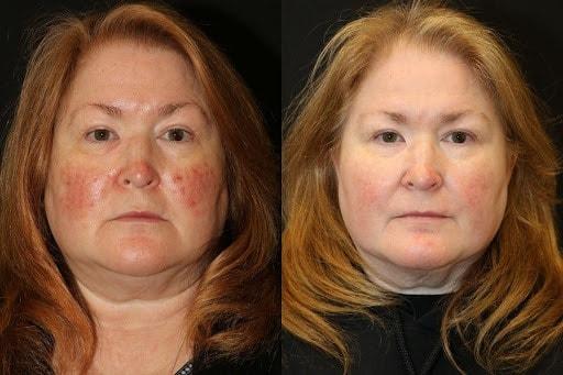 Laser Skin Resurfacing result at Chernoff Cosmetic Surgery in Indianapolis, IN