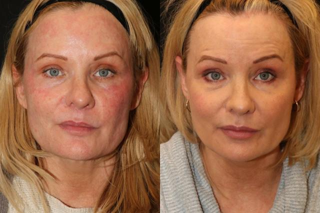 Laser Skin Resurfacing result at Chernoff Cosmetic Surgery in Indianapolis, IN