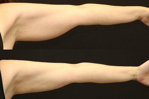 Liposuction result at Chernoff Cosmetic Surgery in Indianapolis, IN