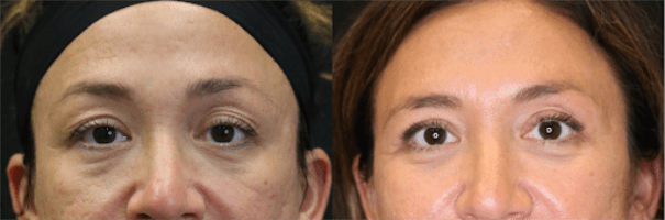 Blepharoplasty result at Chernoff Cosmetic Surgery in Indianapolis, IN