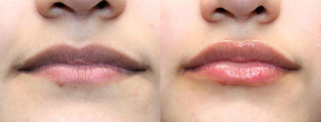 Lip Filler result at Chernoff Cosmetic Surgery in Indianapolis, IN