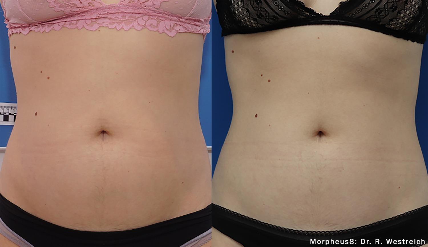 Chernoff Cosmetic Surgery skin tightening result — Indianapolis, IN