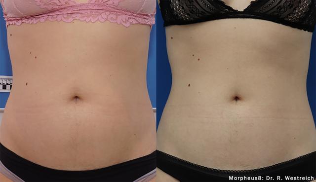 Morpheus8 result at Chernoff Cosmetic Surgery in Indianapolis, IN