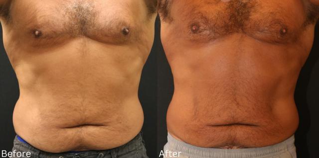 Thigh Lift result at Chernoff Cosmetic Surgery in Indianapolis, IN