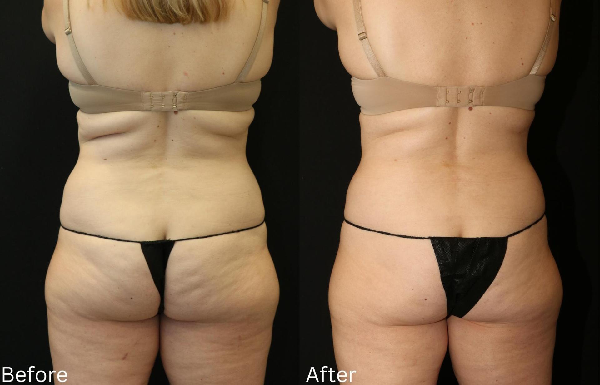 Chernoff Cosmetic Surgery fat freezing result — Indianapolis, IN