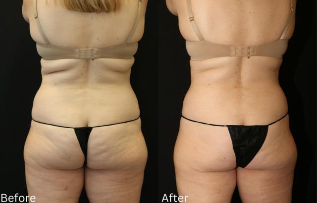 Thigh Lift result at Chernoff Cosmetic Surgery in Indianapolis, IN
